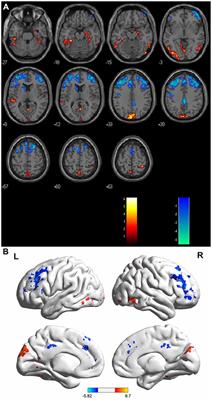 Baseline Brain Activity Changes in Patients With Single and Relapsing Optic Neuritis